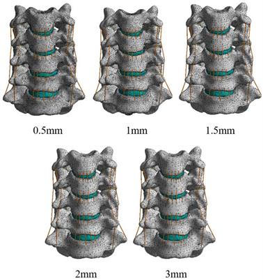 Biomechanical evaluation of a novel anterior transpedicular screw-plate system for anterior cervical corpectomy and fusion (ACCF): a finite element analysis